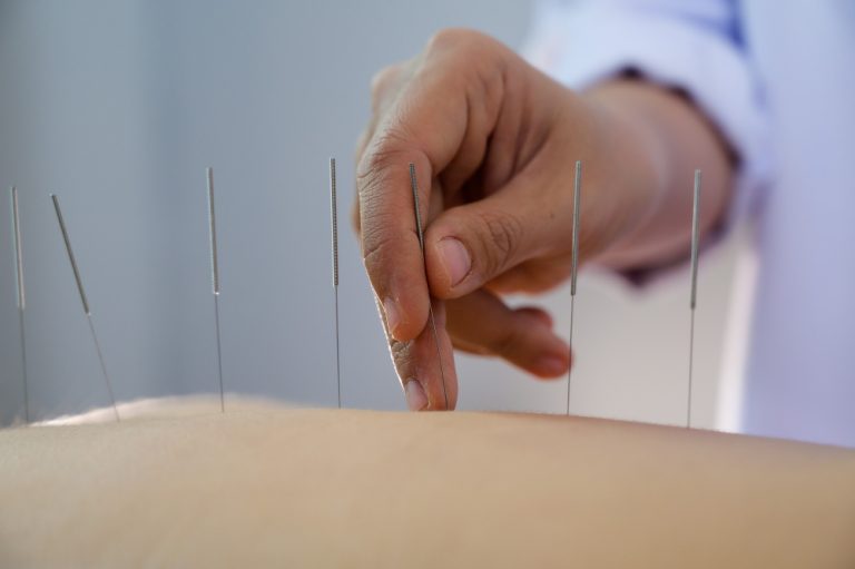 acupunctura